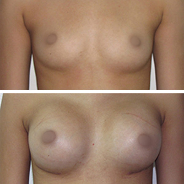 Breast Augmentation