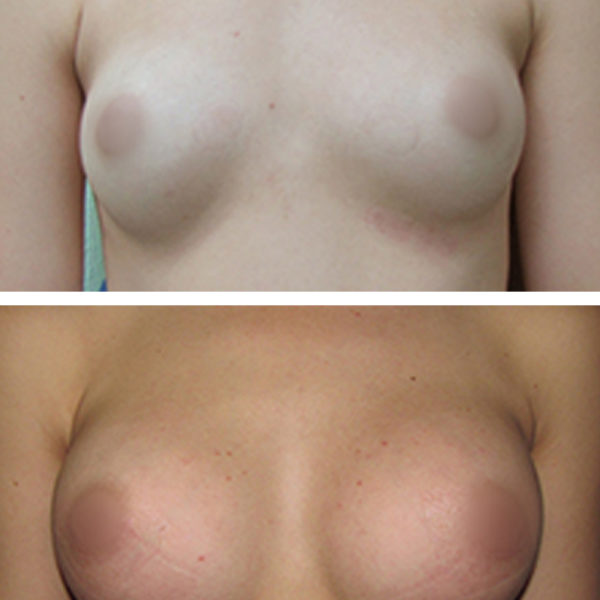 Breast Augmentation