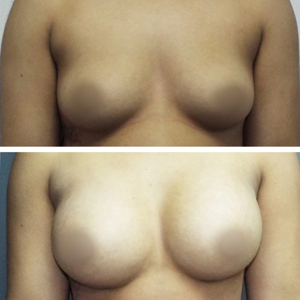 Breast Augmentation