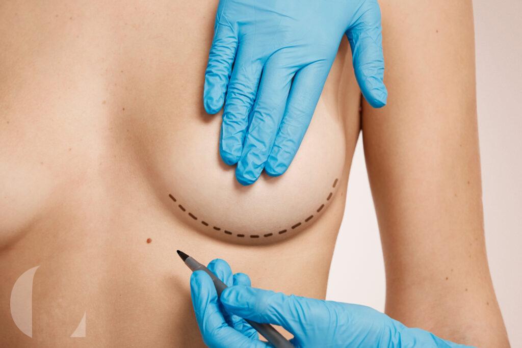 Breast Augmentation aumento de senos